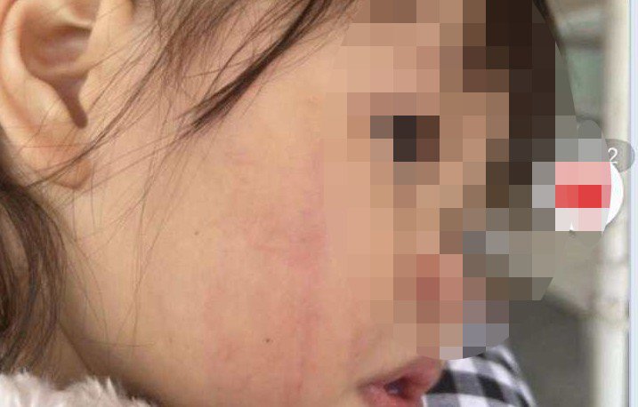 Cháu N được kết luận là xuất huyết trong do vỡ thành mạch. Ảnh gia đình cung cấp Cháu N được kết luận là xuất huyết trong do vỡ thành mạch. Ảnh gia đình cung cấp