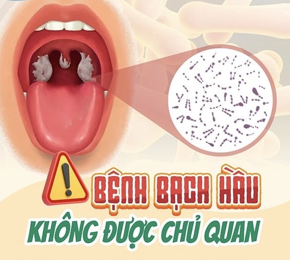 Bạch hầu là bệnh gì, nguy hiểm ra sao?