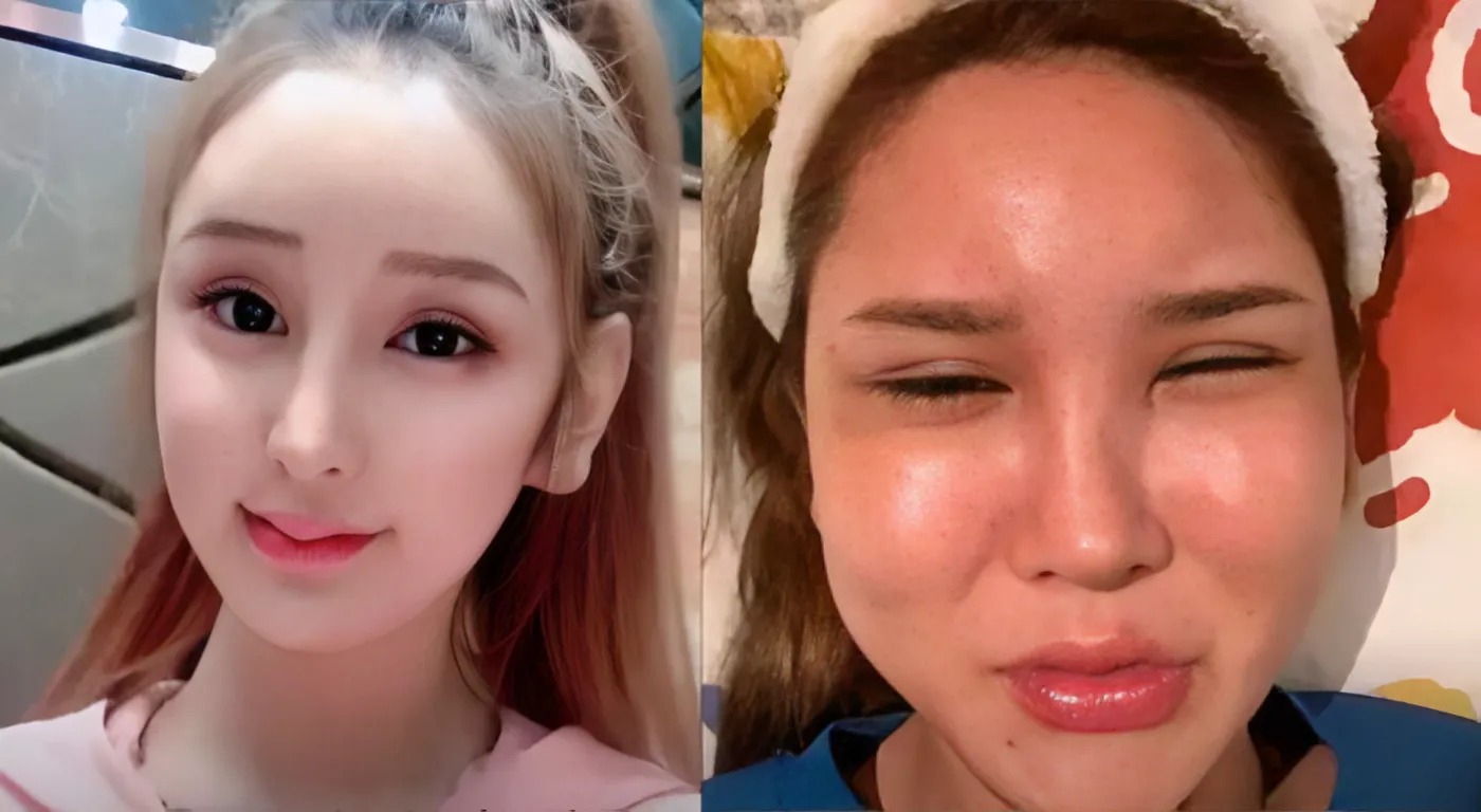 Cô gái tiêm 400 mũi filler, tốn hàng tỷ đồng để 'biến dạng'