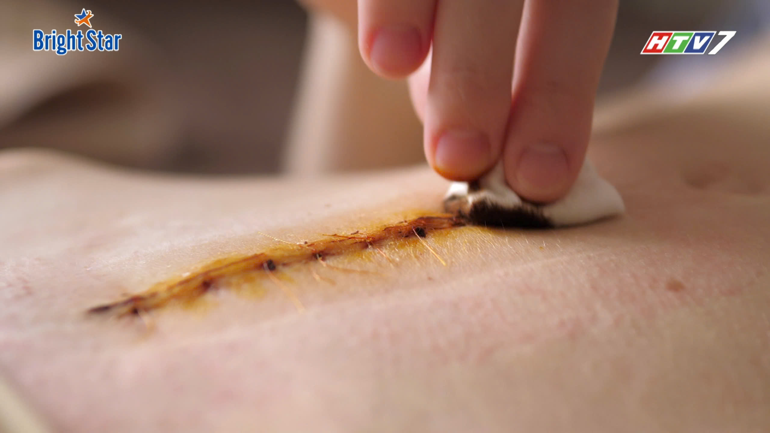 Bác sĩ vui vẻ Phan Sử nói về phẫu thuật thẩm mỹ không dùng chỉ khâu da