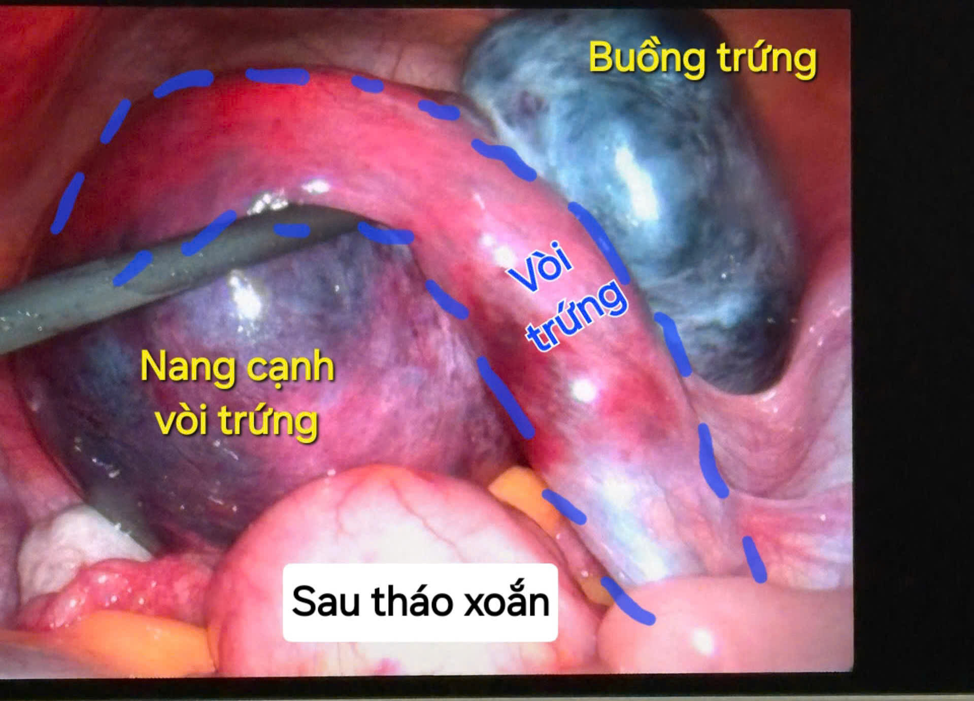 Bệnh viện Lê Văn Việt cấp cứu thành công 2 trường hợp xoắn cơ quan sinh dục 