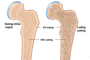 Nguyên nhân khiến nhiều người trẻ mắc bệnh loãng xương