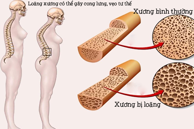 Nguyên nhân khiến nhiều người trẻ mắc bệnh loãng xương