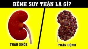 Suy thận là tình trạng thận bị mất chức năng, không còn khả năng lọc các chất thải từ máu.