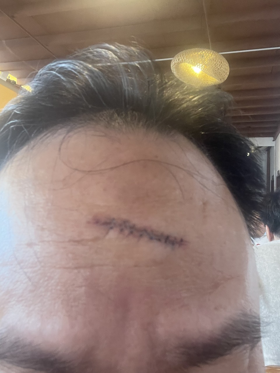 Trán Dr. Phan Sử khi còn khâu chỉ.