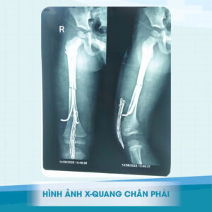Cấp cứu bé trai 4 tuổi chạy ra đường bị TNGT chấn thương nặng 