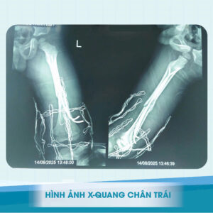 Cấp cứu bé trai 4 tuổi chạy ra đường bị TNGT chấn thương nặng