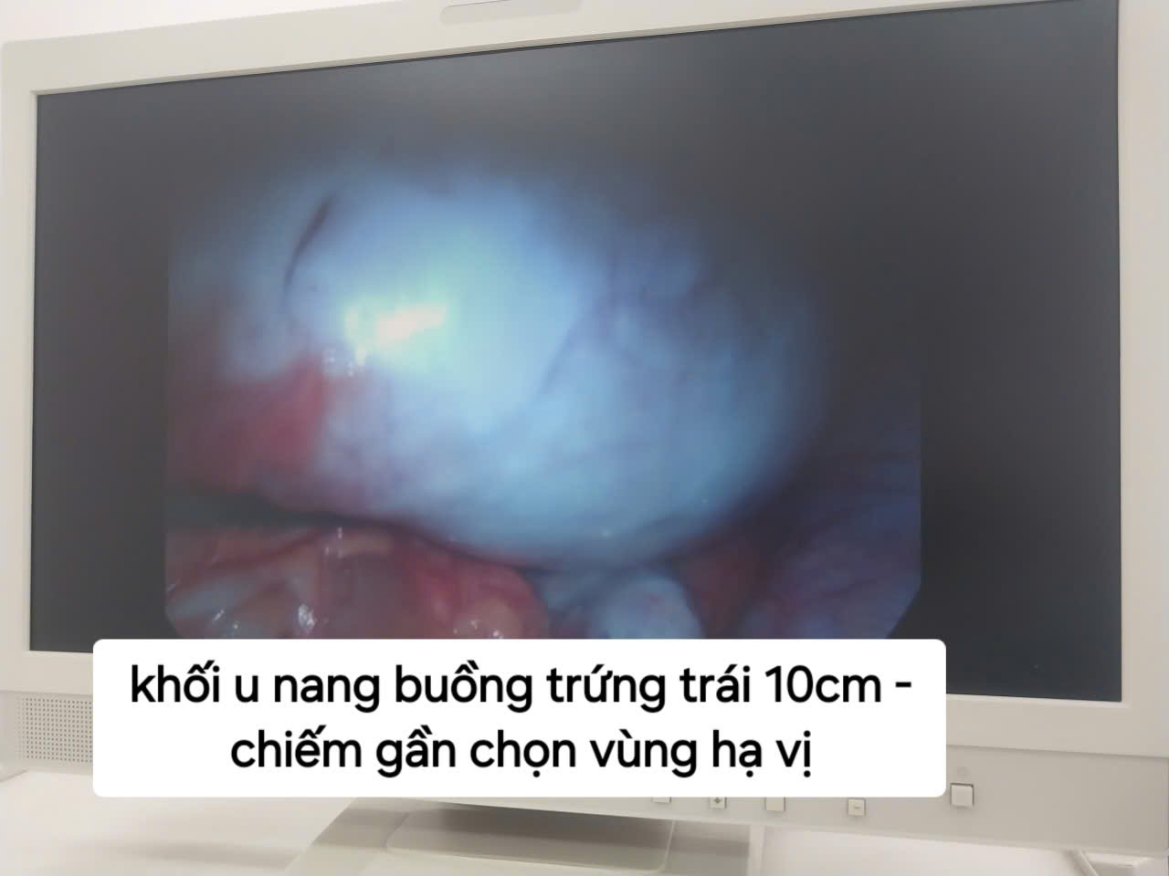 Khối u nang buồng trứng trái 10cm, chiếm gần trọn vùng hạ vị qua camera nội soi.