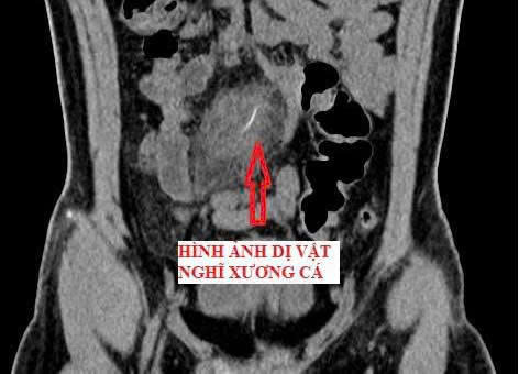Bệnh viện Lê Văn Việt phẫu thuật thành công ca áp xe ổ bụng hiếm gặp do mắc xương cá