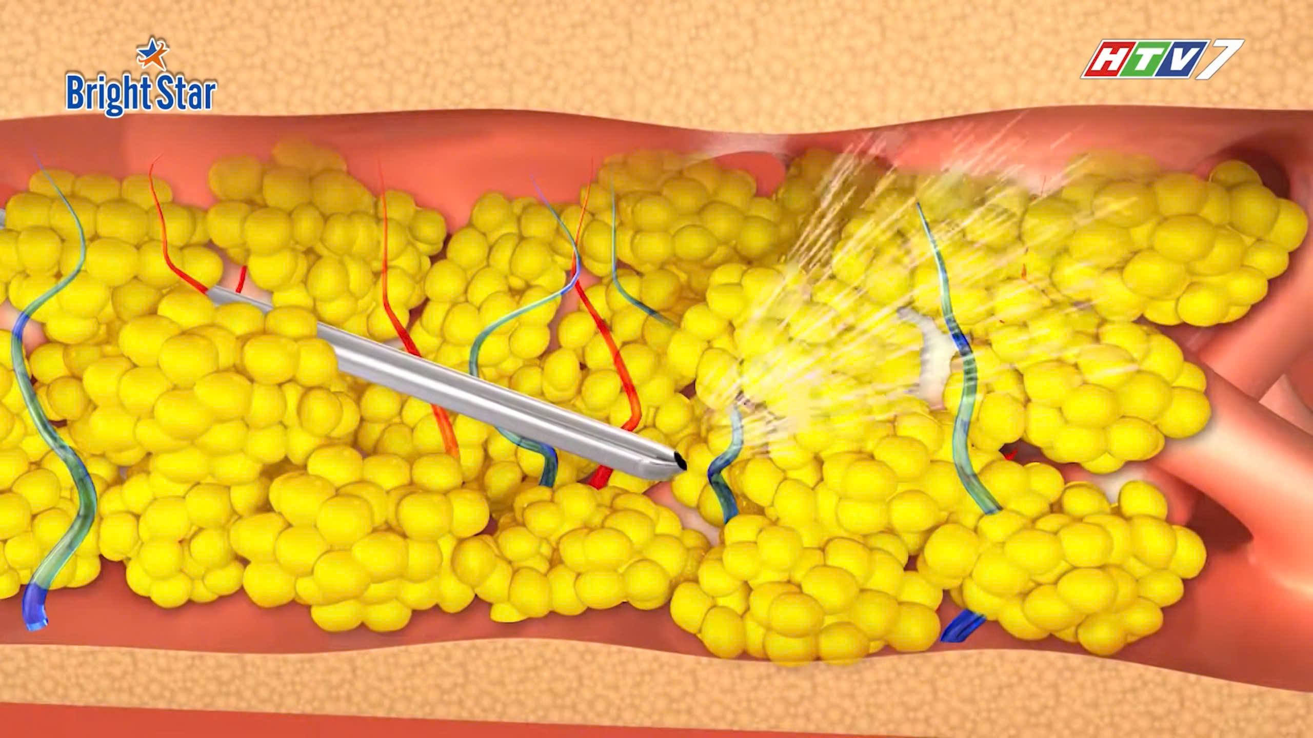 Vì sao nội soi giảm mỡ trở thành bước ngoặt trong làm đẹp?