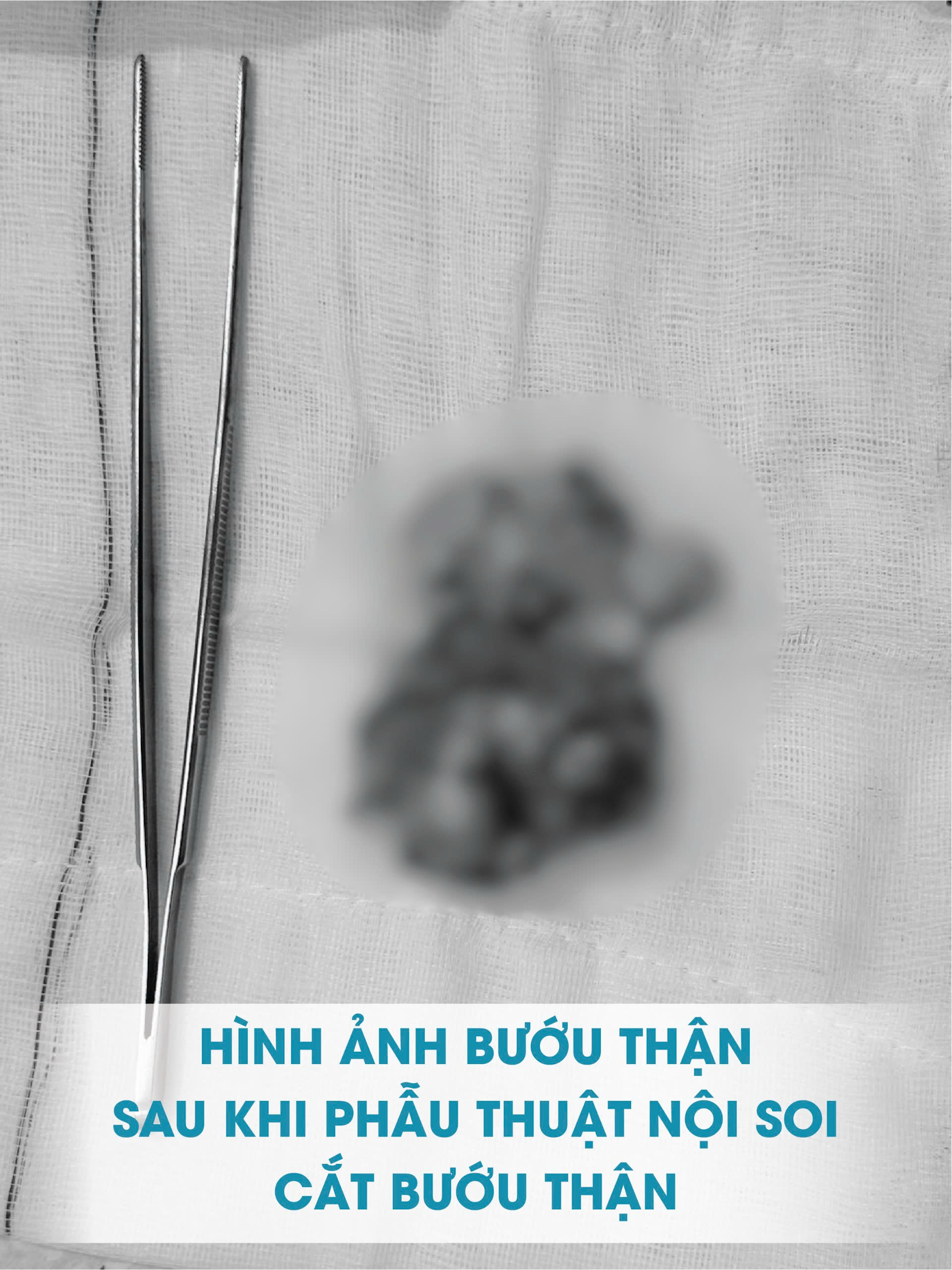 Bước tiến mới trong điều trị u thận tại Bệnh viện Đại học Y Dược – Hoàng Anh Gia Lai