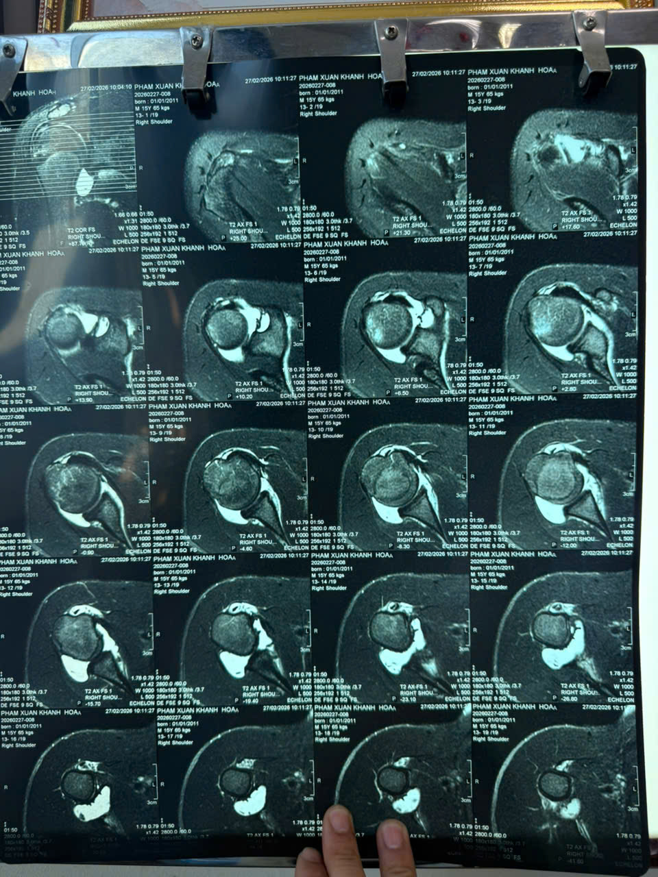 Trật khớp vai tái diễn – nỗi ám ảnh của vận động viên