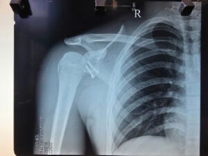 Tại Bệnh viện Đại học Y Dược – Hoàng Anh Gia Lai, kỹ thuật này đã được triển khai hiệu quả trong điều trị các chấn thương thể thao