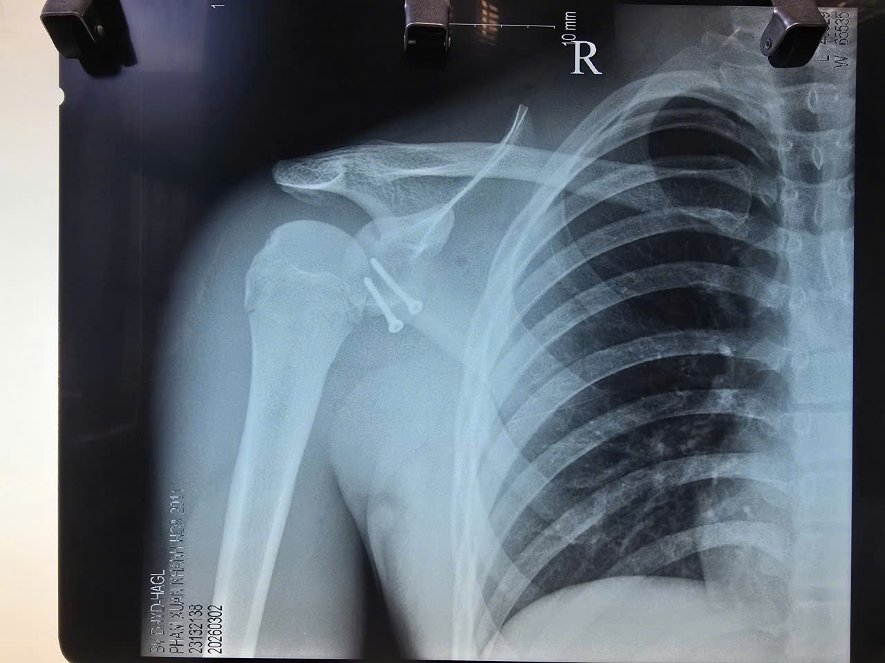 Tại Bệnh viện Đại học Y Dược – Hoàng Anh Gia Lai, kỹ thuật này đã được triển khai hiệu quả trong điều trị các chấn thương thể thao