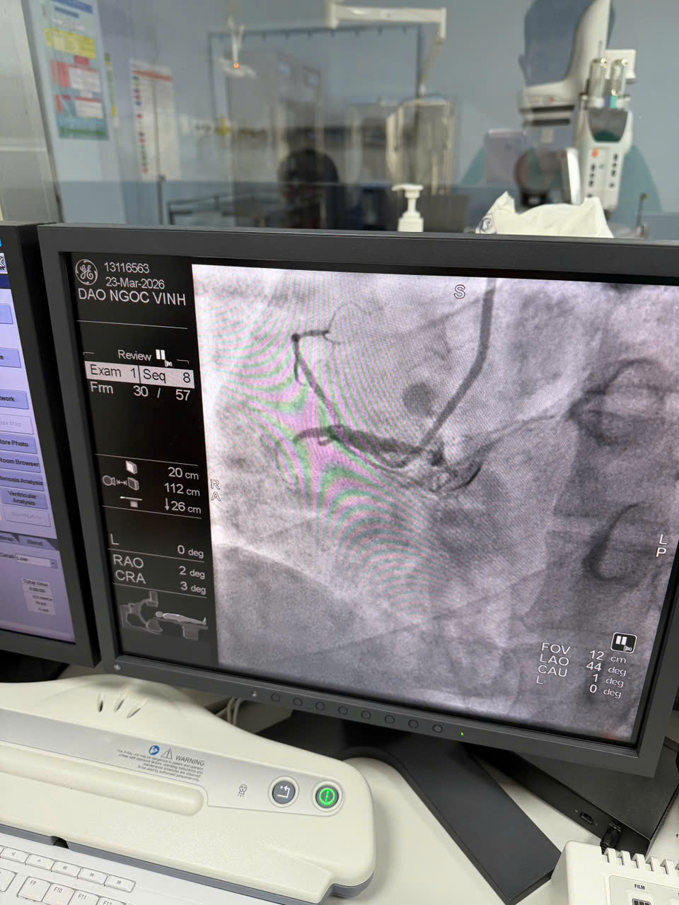 Hình ảnh vị trí mạch máu bị tắc nghẽn của bệnh nhân Đ.N.V.