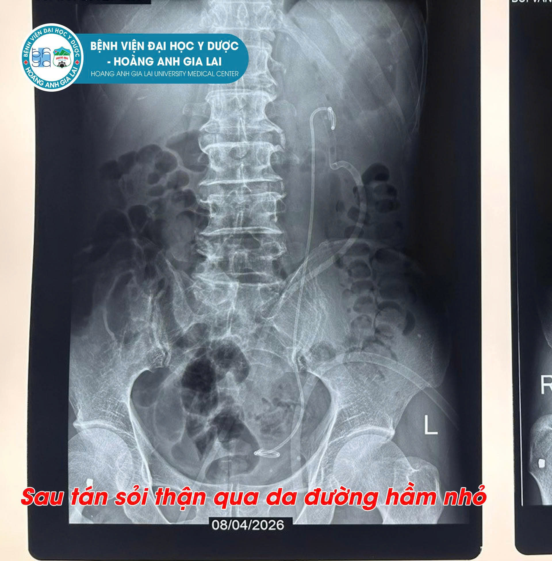 Sỏi thận là một trong những bệnh lý tiết niệu phổ biến, có thể gây đau đớn kéo dài, nhiễm trùng, thậm chí ảnh hưởng đến chức năng thận nếu không được điều trị kịp thời