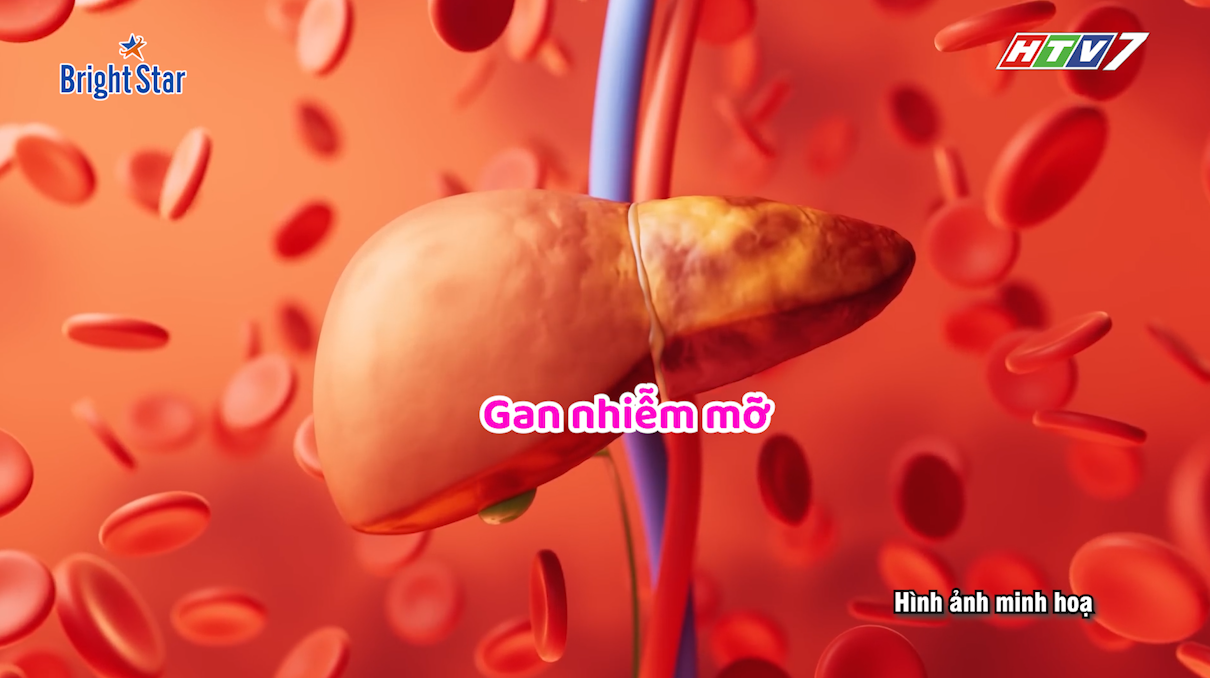 Gan nhiễm mỡ: Đừng để những lời đồn đánh lừa bạn!
