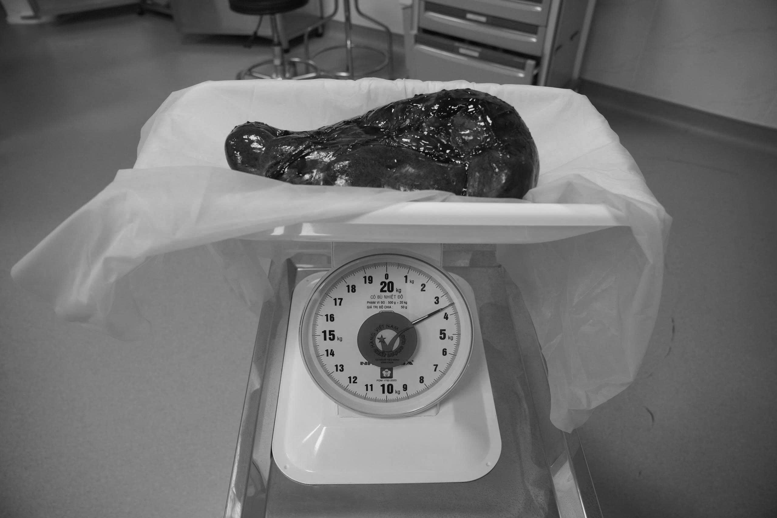 Lá lách nặng 3,5 kg gây chèn ép ổ bụng, được phẫu thuật thành công tại Bệnh viện Hùng Vương Gia Lai
