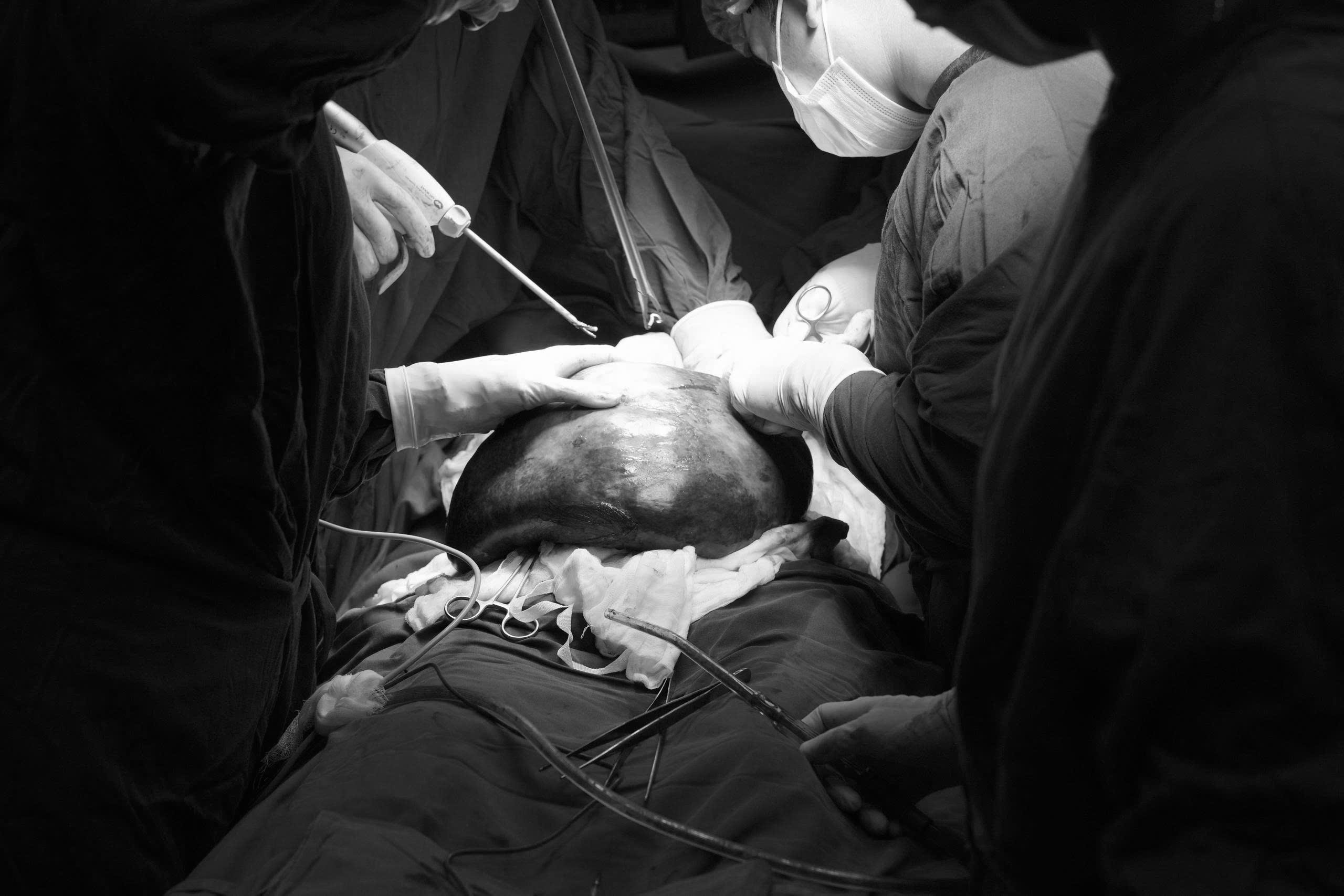 Lá lách nặng 3,5 kg gây chèn ép ổ bụng, được phẫu thuật thành công tại Bệnh viện Hùng Vương Gia Lai